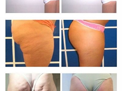 ShockWave_Therapy_Cellulite_Removel_Instead_of_M6.jpg